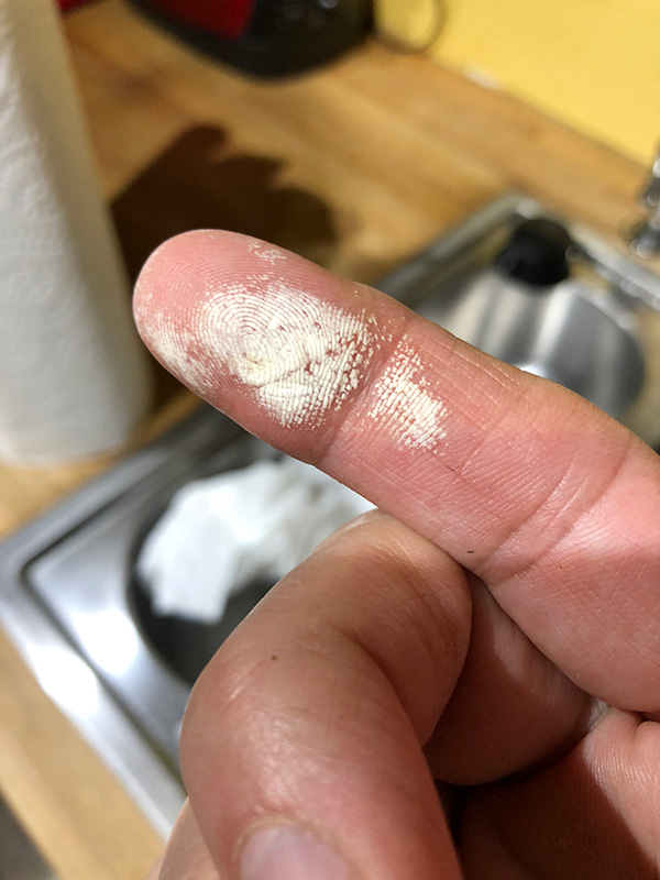 fingers-chem-burn2